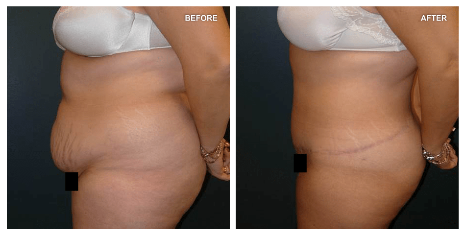 Abdominoplasty and Liposuction, female, age not given, 13 months after surgery by Kenneth Shestak, MD